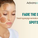 Best Treatment for Hyperpigmentation Guide